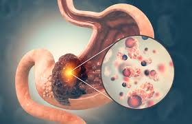 Mide Kanseri - Tıbbi Görsel